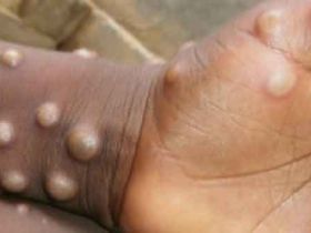 猴痘病毒及其命名